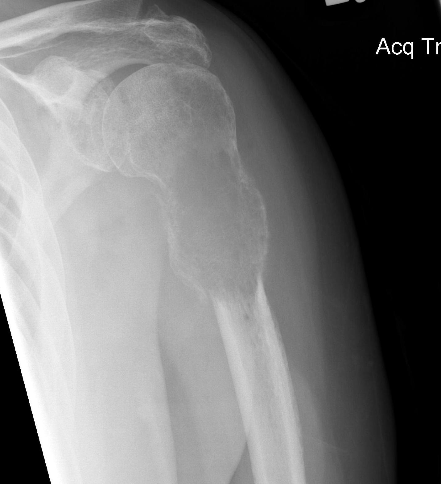 Shoulder Renal Cell Carcinoma